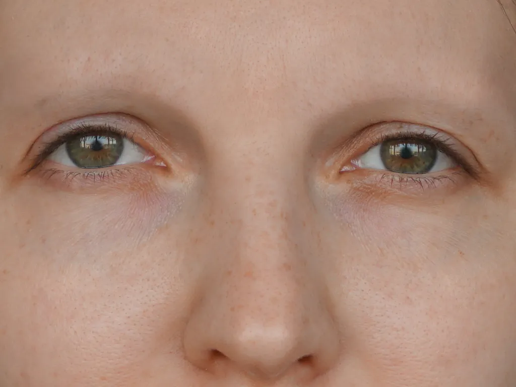 Kahle Augenbrauen - Augenbrauentransplantation Muster